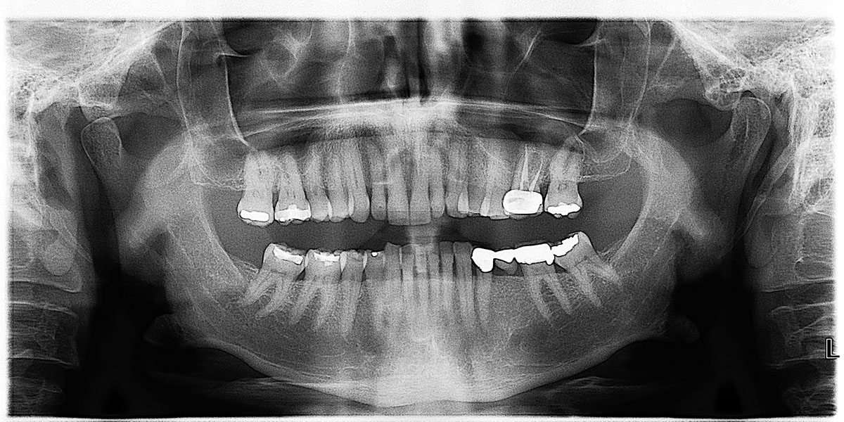 Striking Wrap Around Teeth X-Ray.